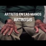 Verrugas y artritis reumatoide