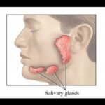 La infección sinusal puede causar inflamación de las glándulas salivales
