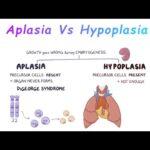 Hipoplasia vs aplasia