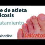 Dermatitis de contacto o pie de atleta