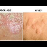 Psoriasis vs herpes