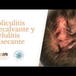 Aparición de celulitis en el cuero cabelludo