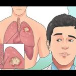 Ganglios linfáticos pulmonares