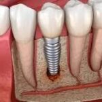 Inflamación de Ganglio Post-Implantes Dentales