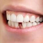¿Por qué mi implante dental huele mal?