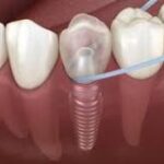 Implante Dental: Una Inversión para Siempre