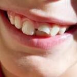 Consejos para un Esmalte Dental Fuerte