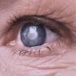 Tratamiento de Glaucoma y Cataratas