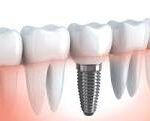 Implante Dental 2.0
